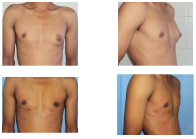 Breast Asymmetry Correction in Pune